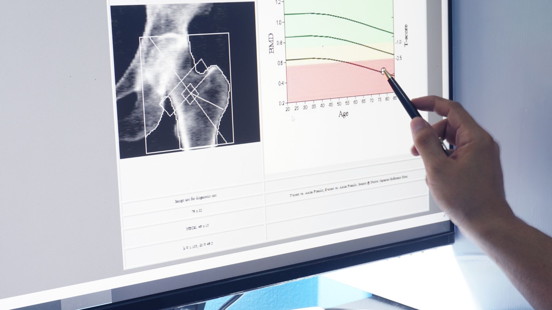 bone density scan results